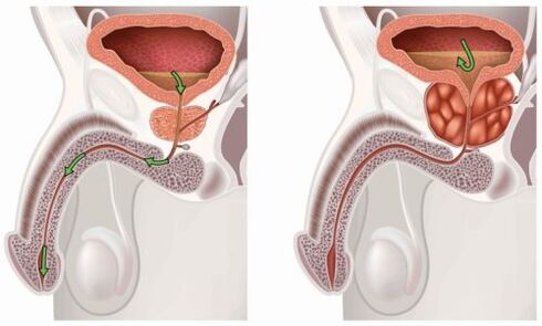 healthy and inflamed prostate with prostatitis