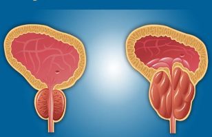 prostatitis the photo