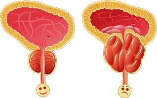 Normal prostate and a lot of