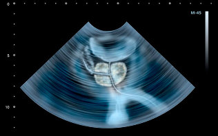 Symptoms of prostatitis in ultrasound