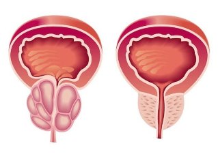 As can be seen prostatitis